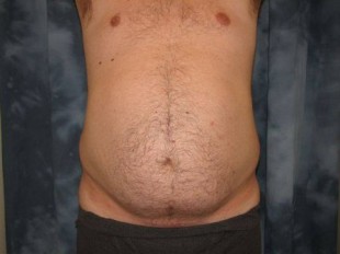 Male Patient 2 – Liposuction