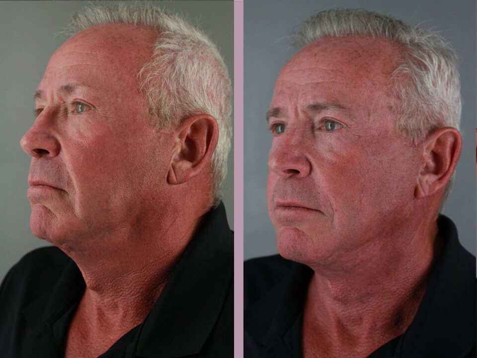 Old Man Before And After Plastic Surgery Telegraph